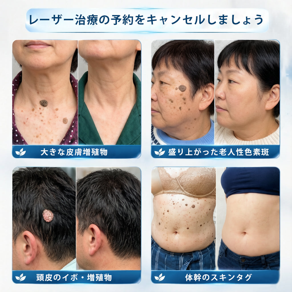 𝐇𝐈𝐒𝐊𝐈𝐍®👩‍⚕️ 7日間 スキンタグ＆スポットイレーサー｜痛みがなく、傷跡を残さない 高機能スポット除去ローラーボールペン