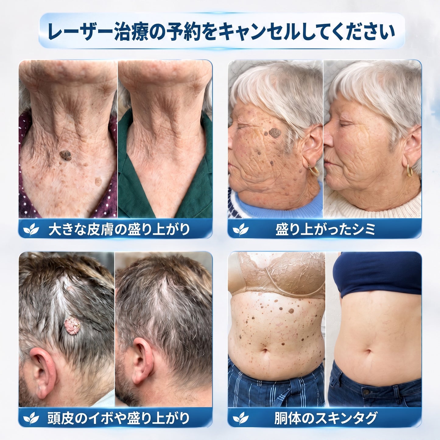 𝐇𝐈𝐒𝐊𝐈𝐍®👩‍⚕️ 7日間 スキンタグ＆スポットイレーサー｜痛みがなく、傷跡を残さない 高機能スポット除去ローラーボールペン